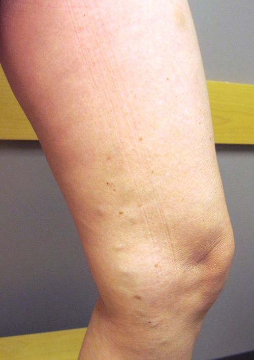 Varicose Veins After