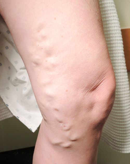 Varicose Veins Before